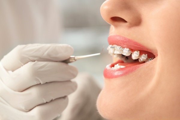 The Benefits Of Braces: More Than Just A Straighter Smile